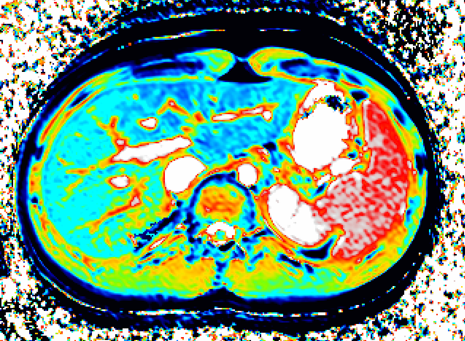 Parametric liver MRI map